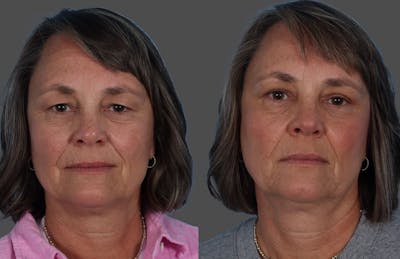 Eyelid Surgery (Blepharoplasty) Before & After Gallery - Patient 284168 - Image 1