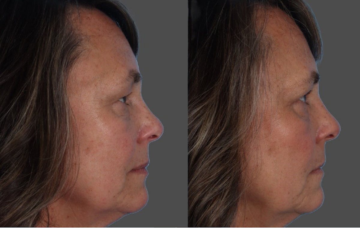 Eyelid Surgery (Blepharoplasty) Before & After Gallery - Patient 284168 - Image 3