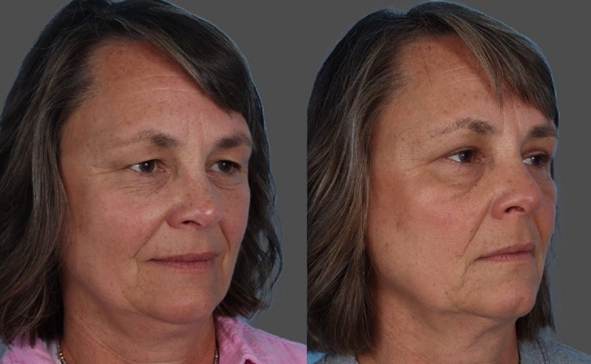 Eyelid Surgery (Blepharoplasty) Before & After Gallery - Patient 284168 - Image 2