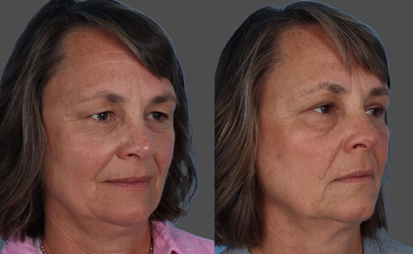 Eyelid Surgery (Blepharoplasty) Before & After Gallery - Patient 284168 - Image 2