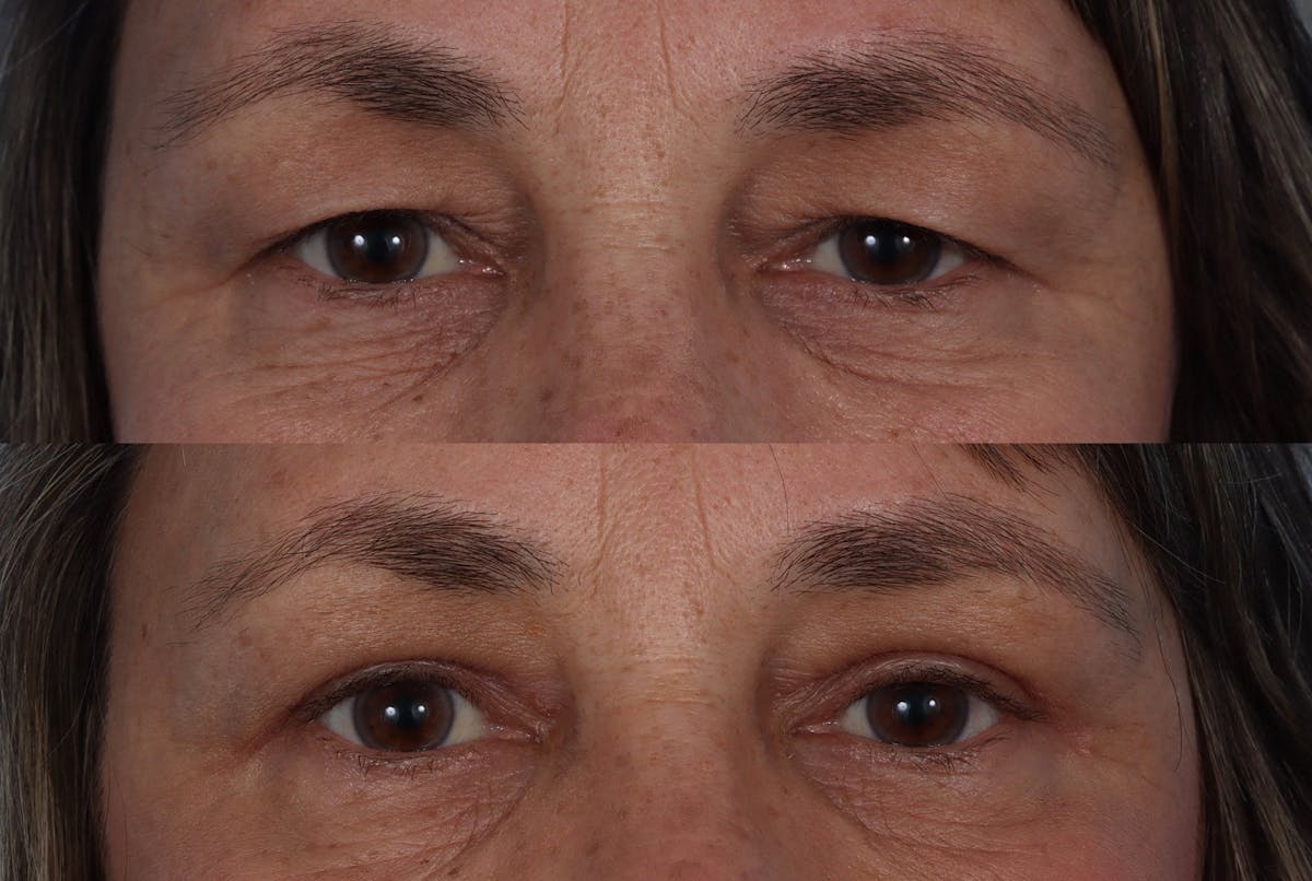 Eyelid Surgery (Blepharoplasty) Before & After Gallery - Patient 284168 - Image 6
