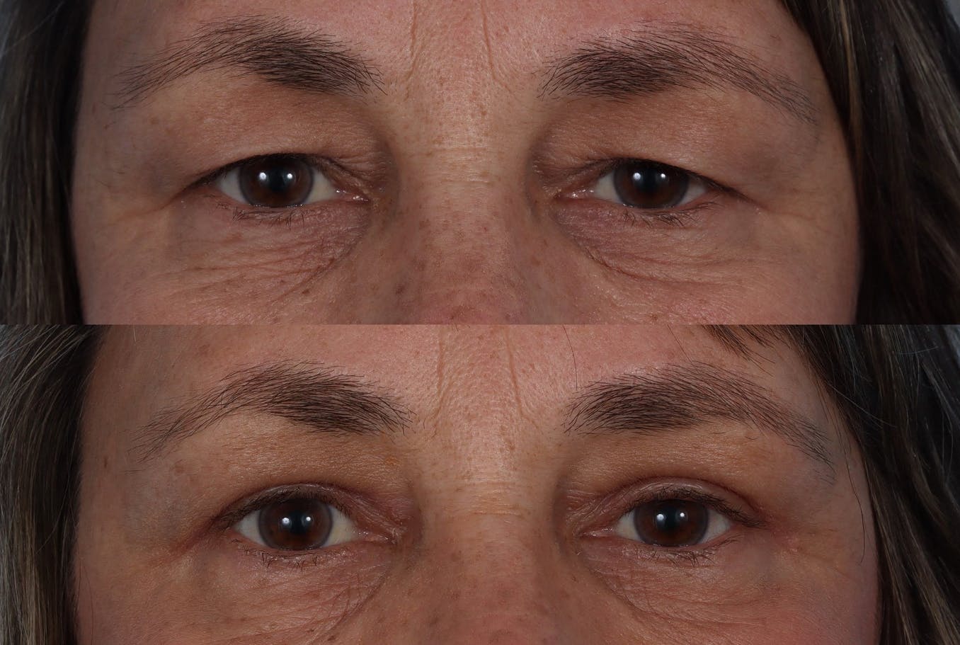 Eyelid Surgery (Blepharoplasty) Before & After Gallery - Patient 284168 - Image 6