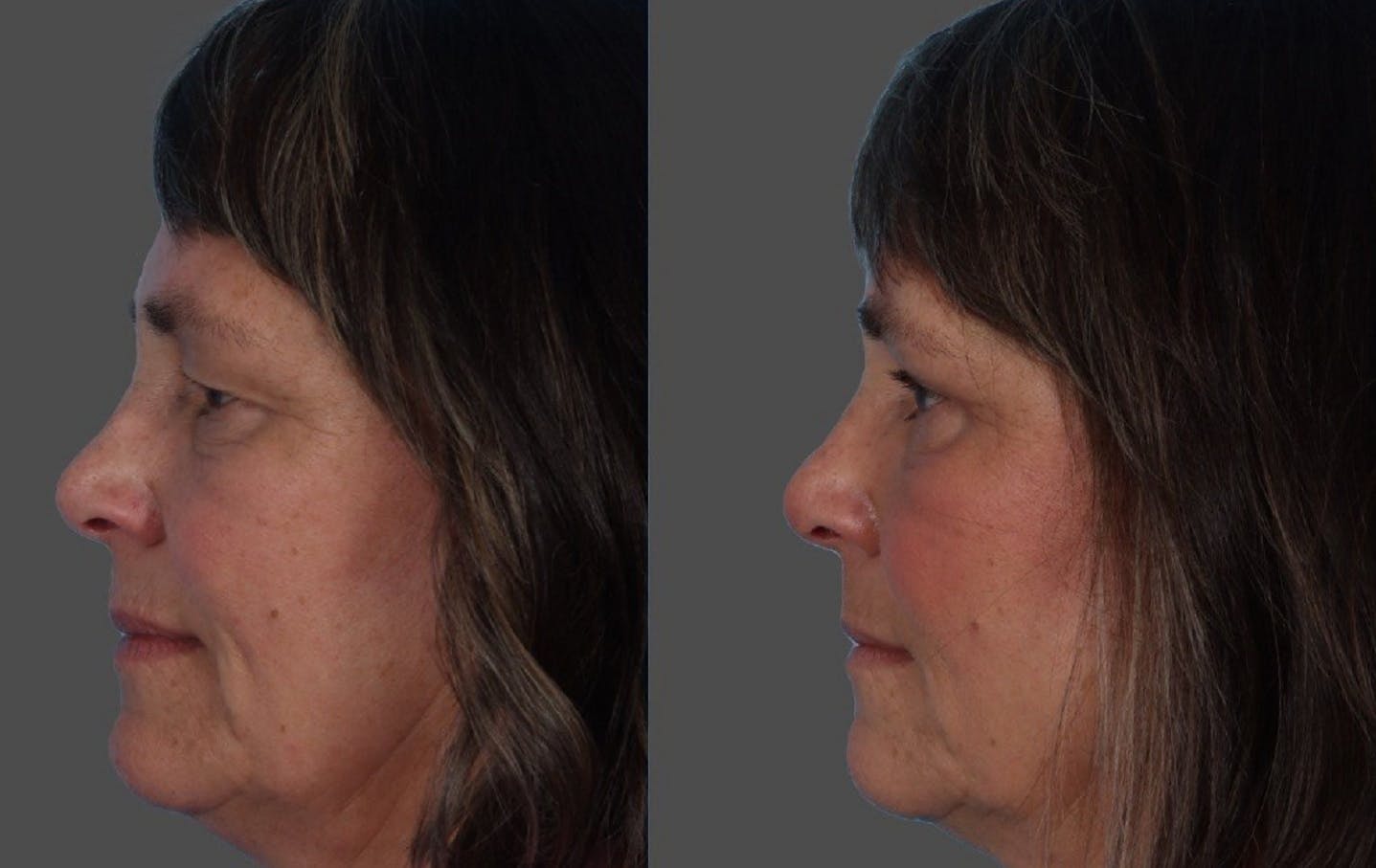 Eyelid Surgery (Blepharoplasty) Before & After Gallery - Patient 284168 - Image 5