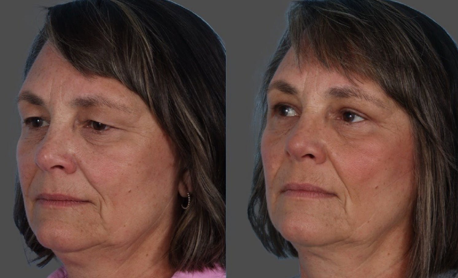 Eyelid Surgery (Blepharoplasty) Before & After Gallery - Patient 284168 - Image 4