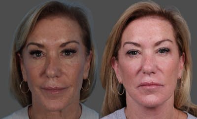 Facelift Before & After Gallery - Patient 361276 - Image 1