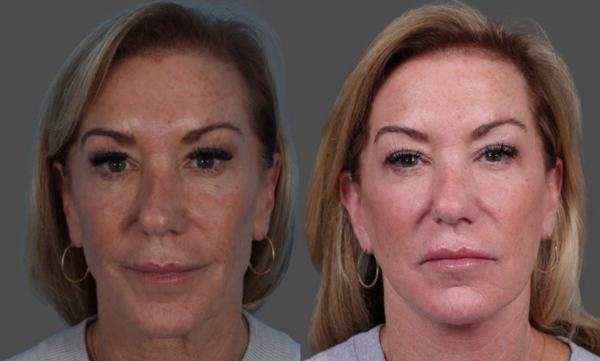 Facelift Before & After Gallery - Patient 361276 - Image 1