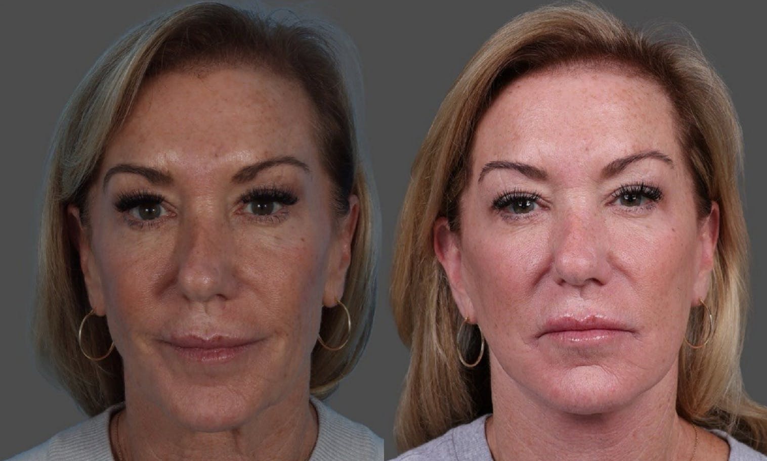 Facelift Before & After Gallery - Patient 361276 - Image 1