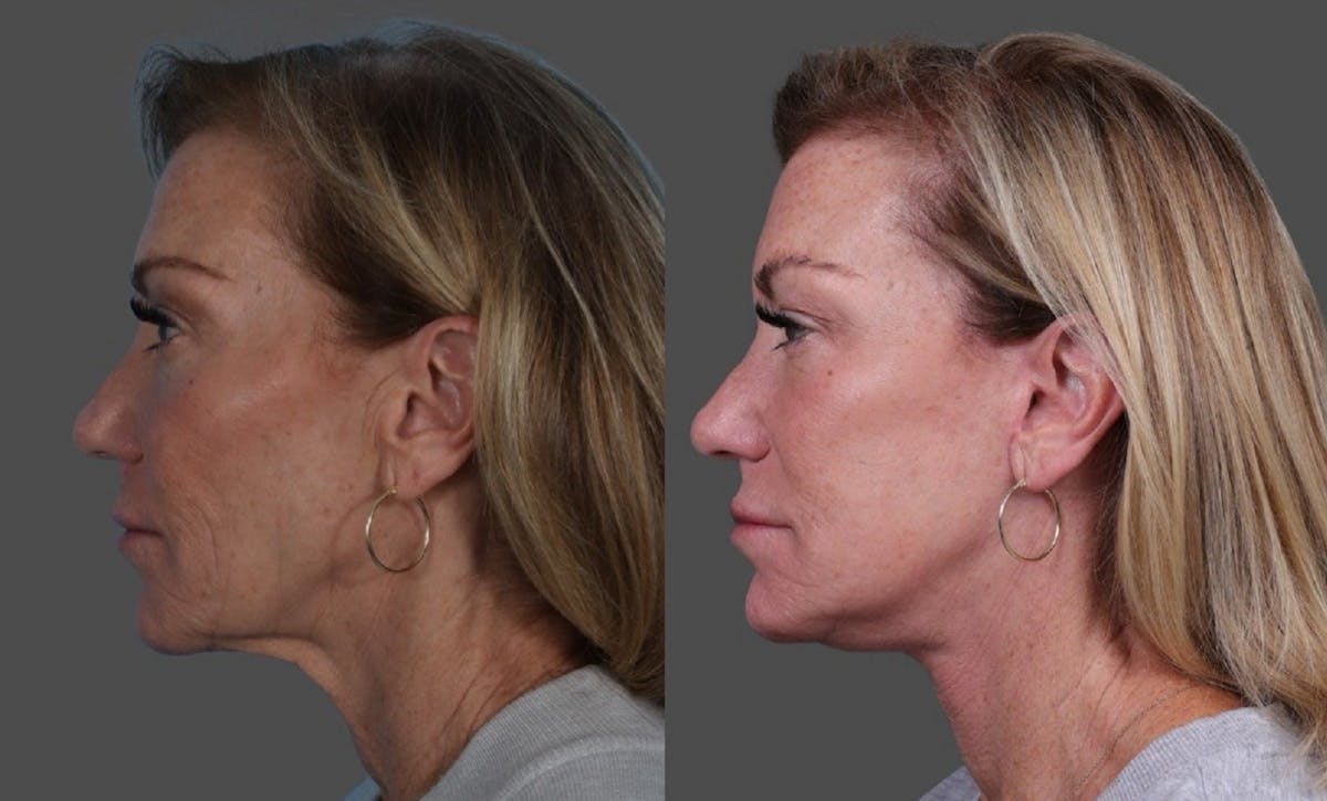 Facelift Before & After Gallery - Patient 361276 - Image 5