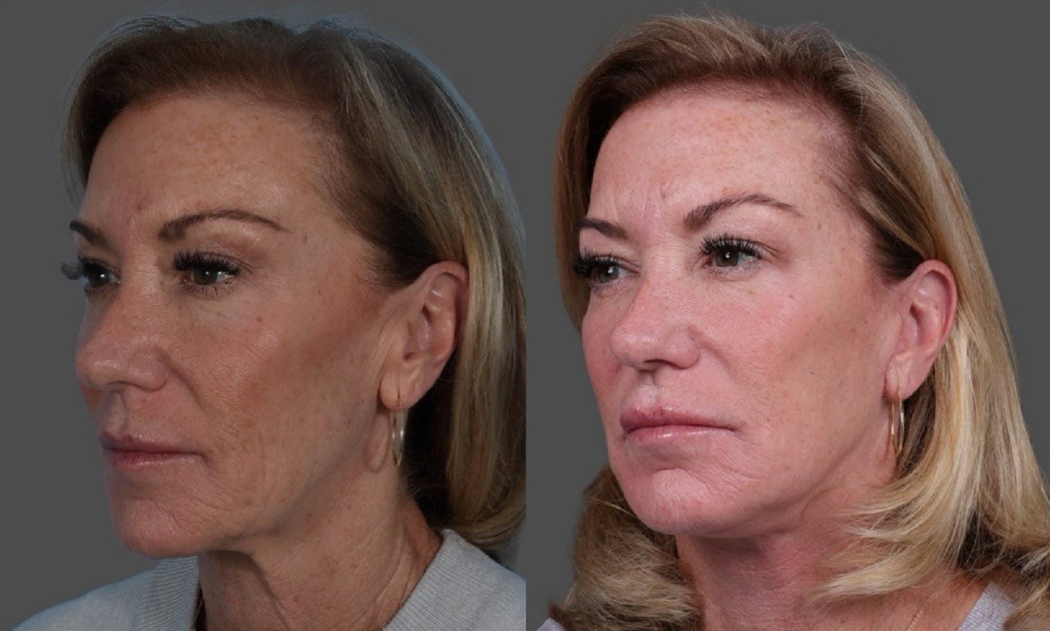 Facelift Before & After Gallery - Patient 361276 - Image 4