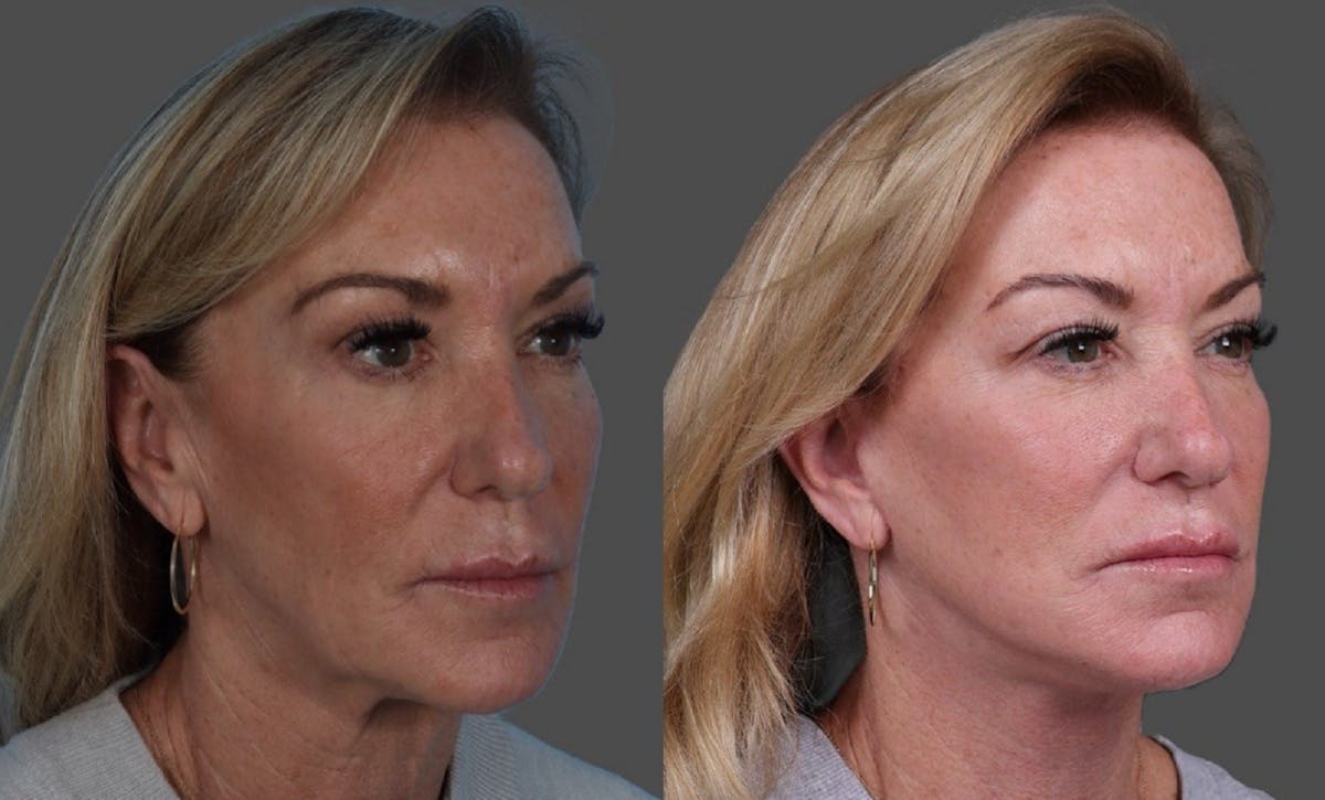 Facelift Before & After Gallery - Patient 361276 - Image 2