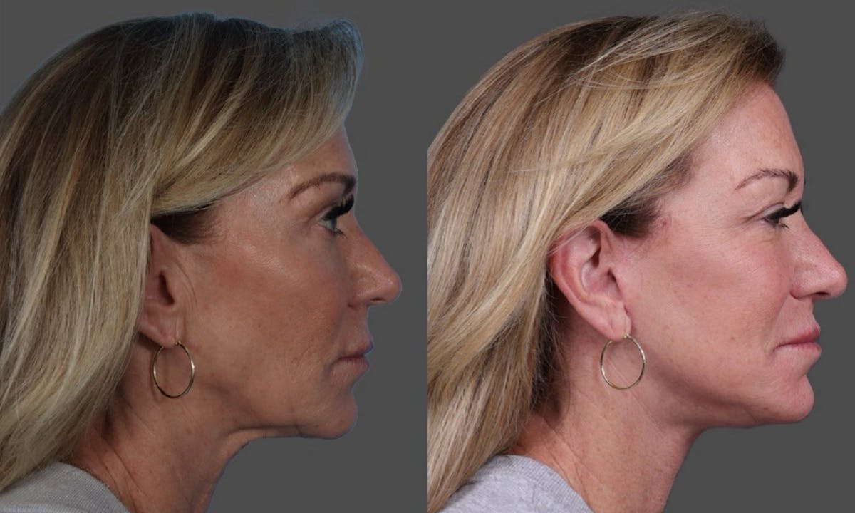Facelift Before & After Gallery - Patient 361276 - Image 3
