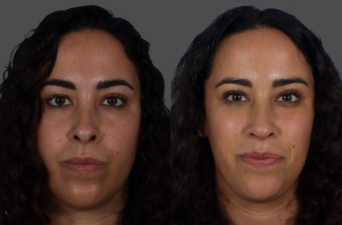 Rhinoplasty Before & After Gallery - Patient 381429 - Image 3