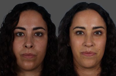 Eyelid Surgery (Blepharoplasty) Before & After Gallery - Patient 100386 - Image 1