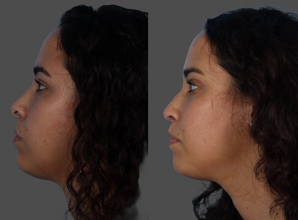 Rhinoplasty Before & After Gallery - Patient 381429 - Image 5