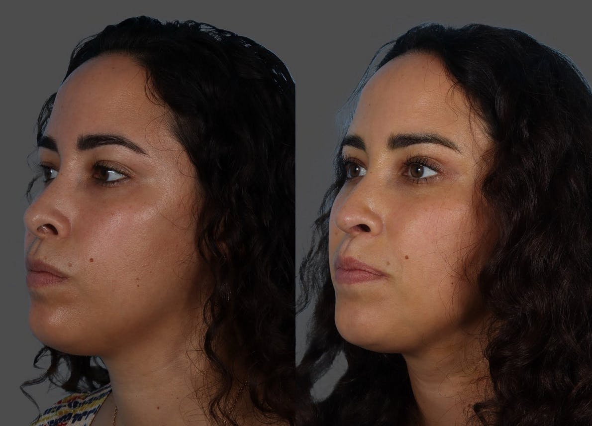 Rhinoplasty Before & After Gallery - Patient 381429 - Image 4