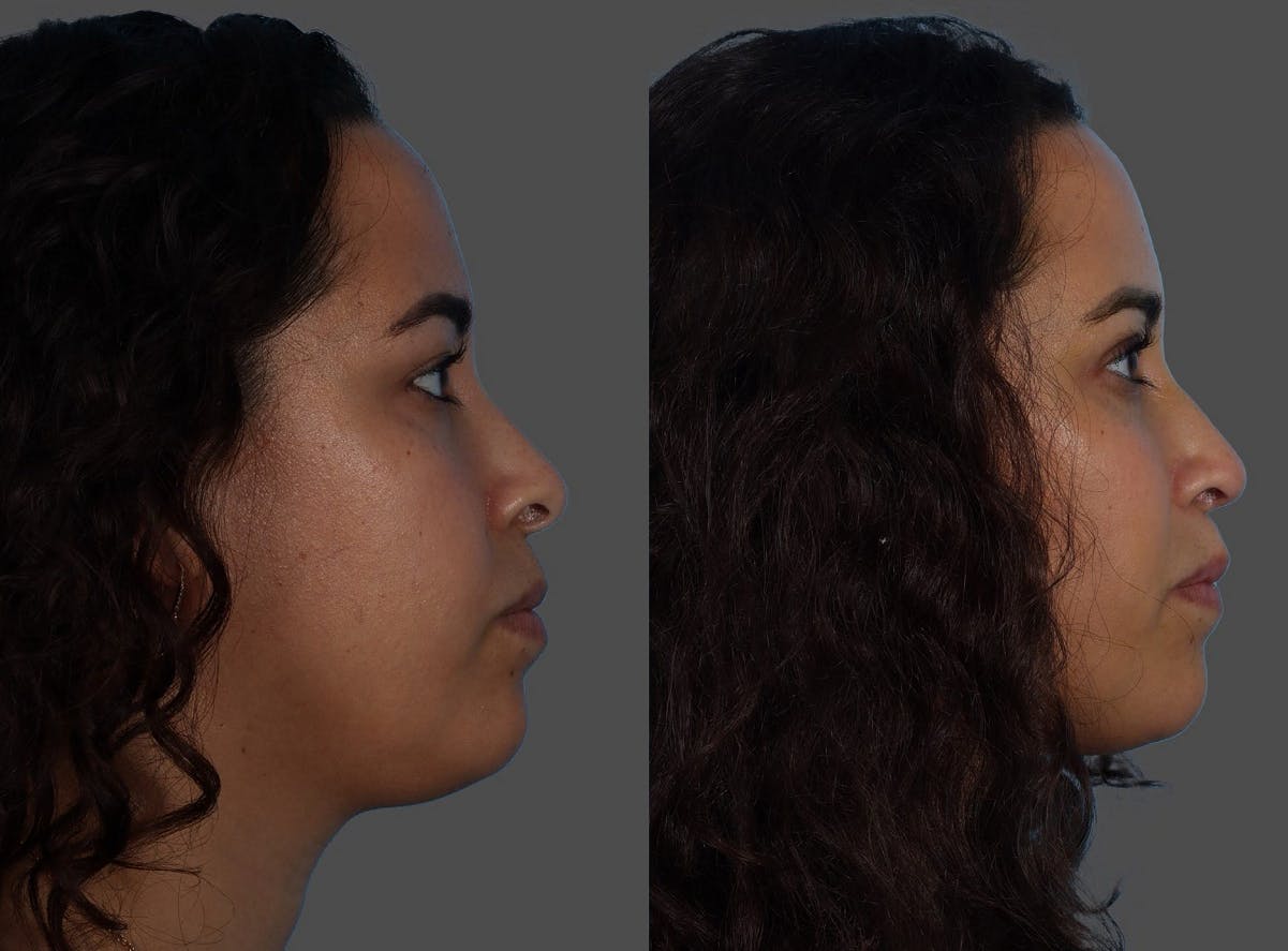 Rhinoplasty Before & After Gallery - Patient 381429 - Image 1