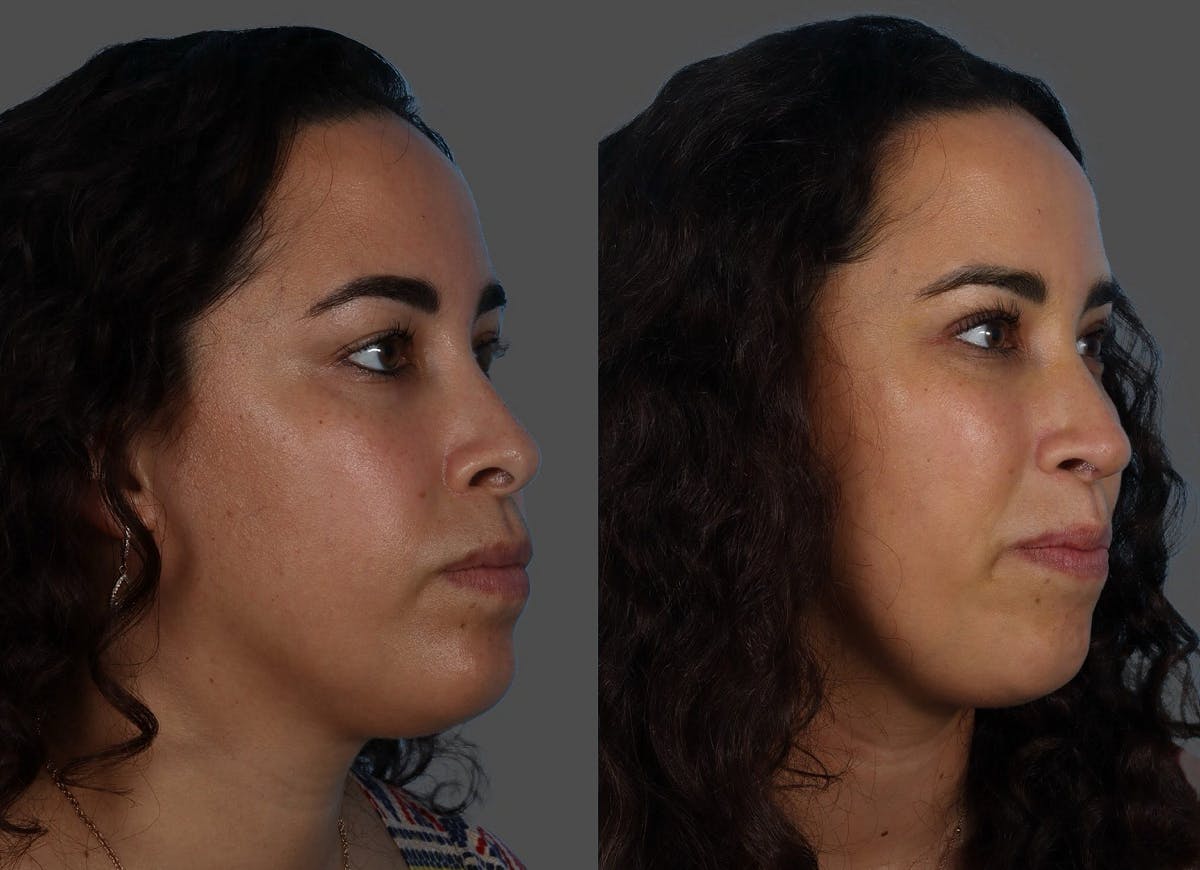Rhinoplasty Before & After Gallery - Patient 381429 - Image 2