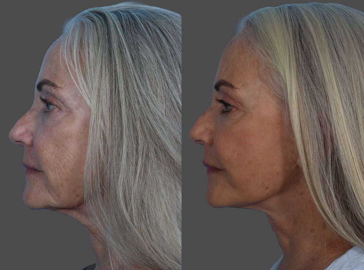 Facelift Before & After Gallery - Patient 206623 - Image 5