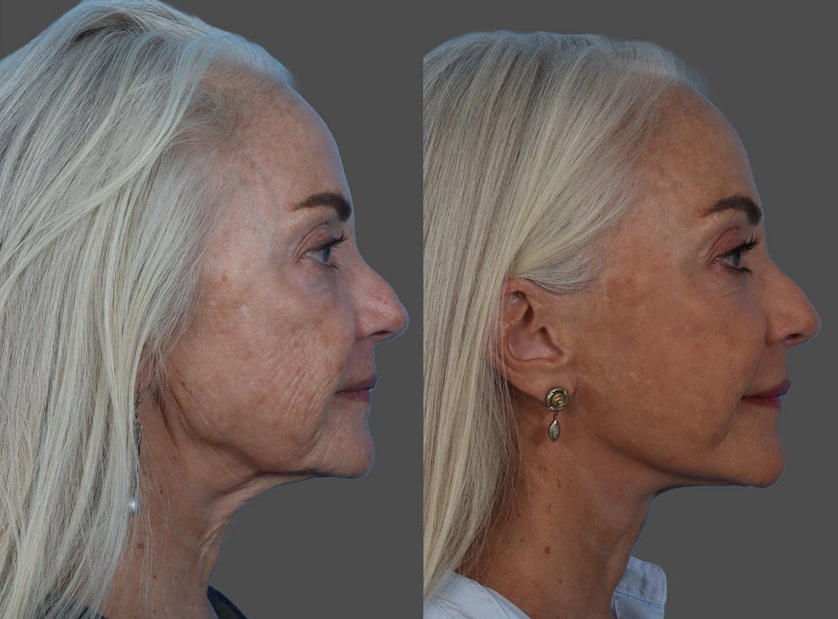 Facelift Before & After Gallery - Patient 206623 - Image 3