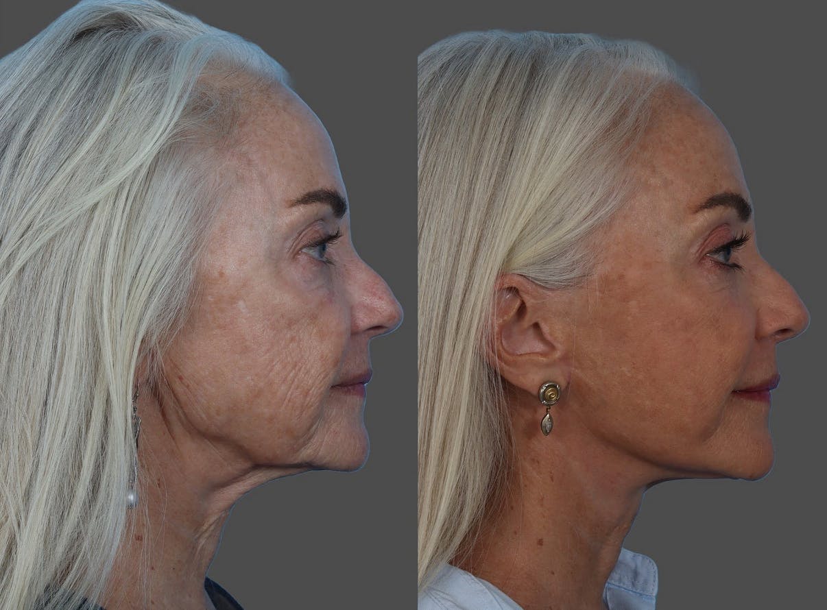 Facelift Before & After Gallery - Patient 206623 - Image 3