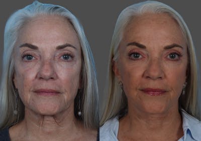 Facelift Before & After Gallery - Patient 206623 - Image 1