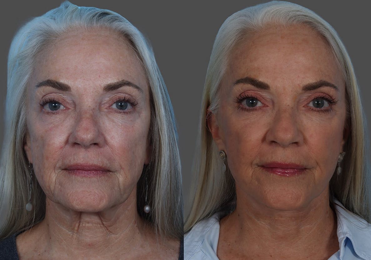 Facelift Before & After Gallery - Patient 206623 - Image 1
