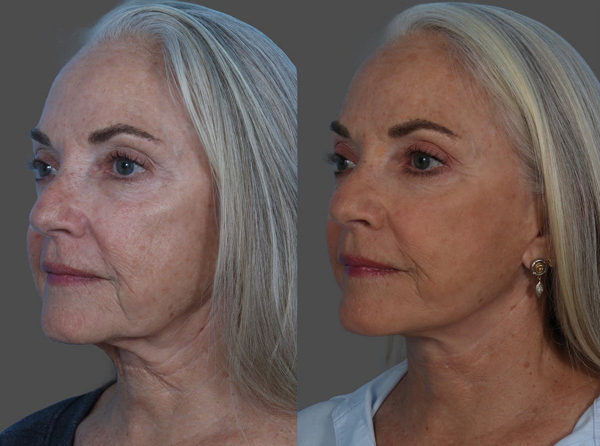 Facelift Before & After Gallery - Patient 206623 - Image 4