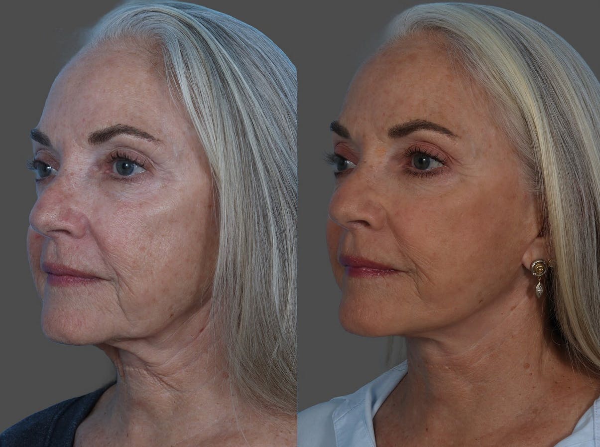 Facelift Before & After Gallery - Patient 206623 - Image 4