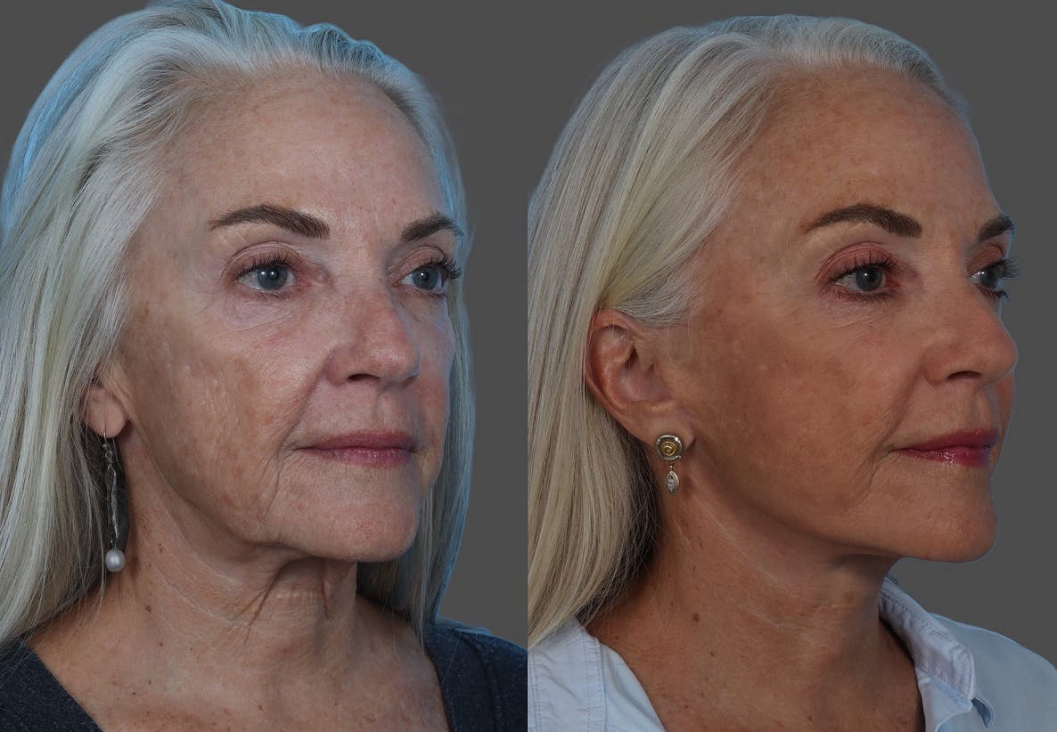Facelift Before & After Gallery - Patient 206623 - Image 2