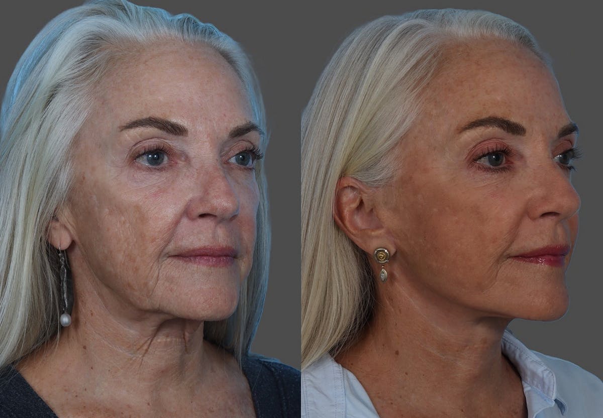 Facelift Before & After Gallery - Patient 206623 - Image 2