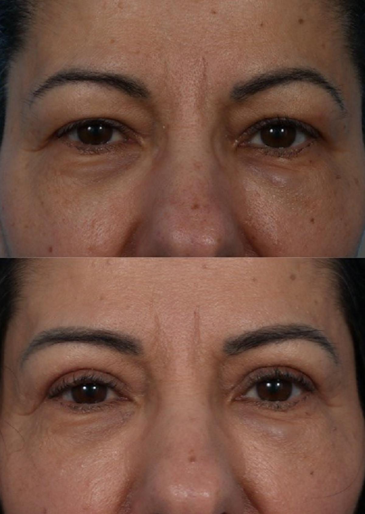 Eyelid Surgery (Blepharoplasty) Before & After Gallery - Patient 369727 - Image 6