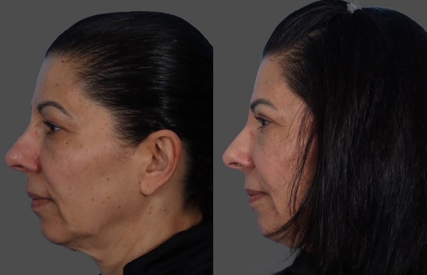 Eyelid Surgery (Blepharoplasty) Before & After Gallery - Patient 369727 - Image 5