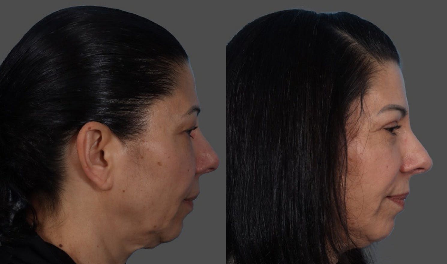 Eyelid Surgery (Blepharoplasty) Before & After Gallery - Patient 369727 - Image 3