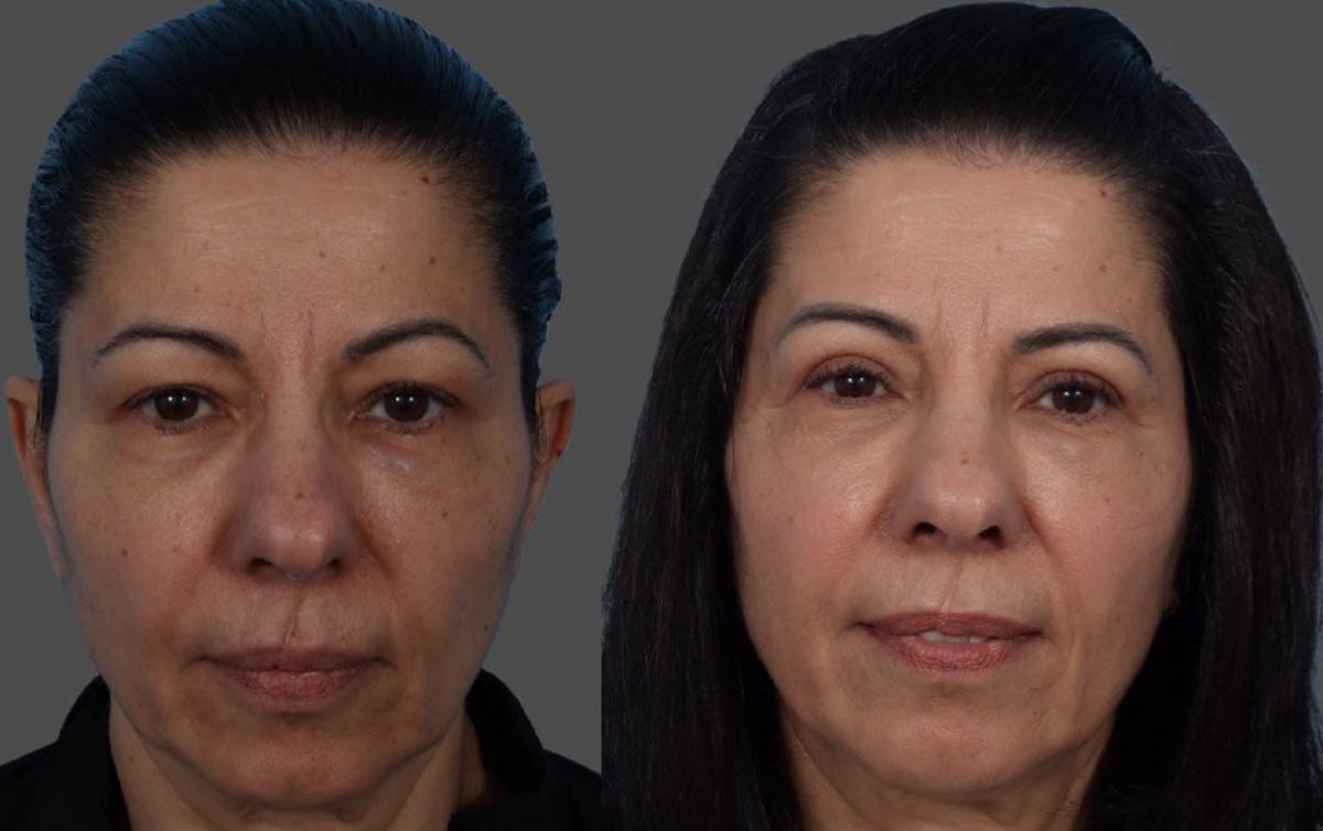 Eyelid Surgery (Blepharoplasty) Before & After Gallery - Patient 369727 - Image 1