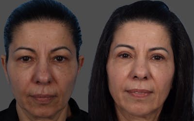 Eyelid Surgery (Blepharoplasty) Before & After Gallery - Patient 369727 - Image 1