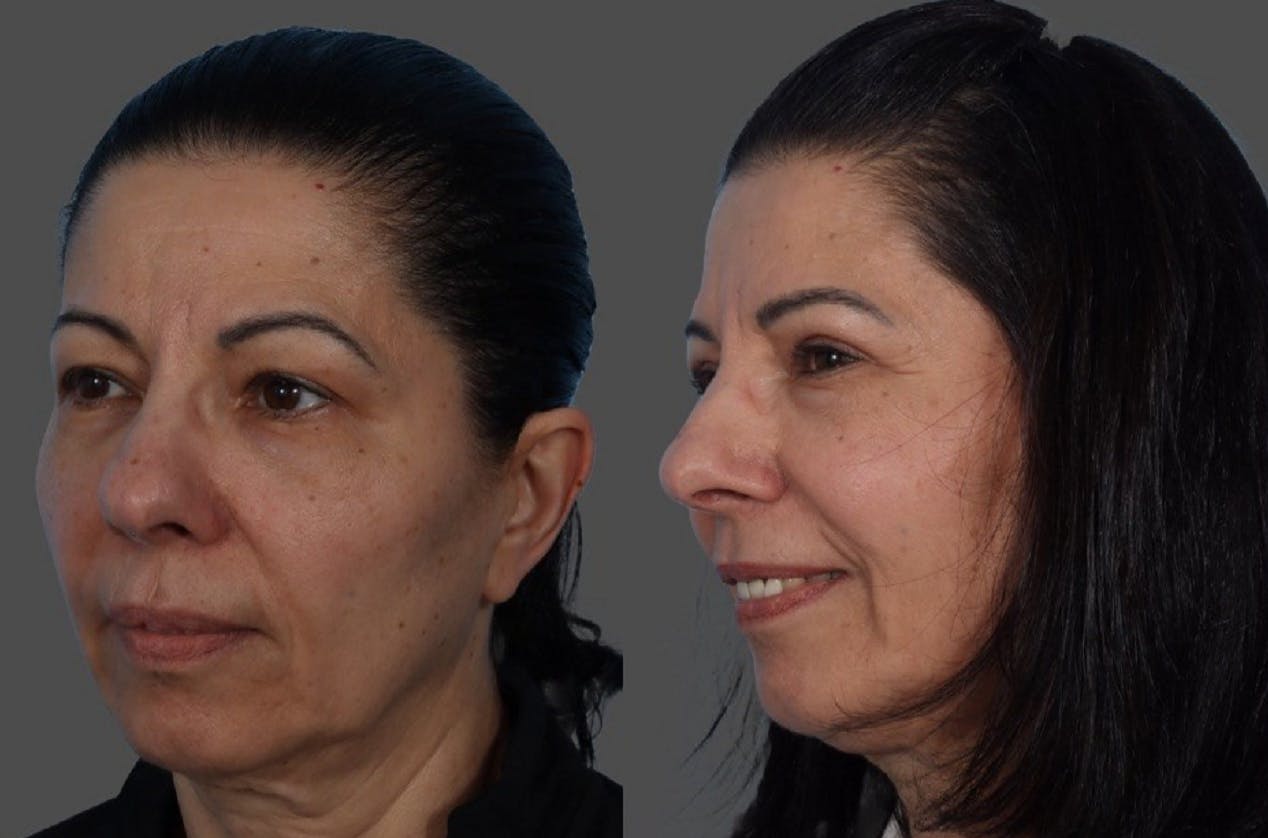Eyelid Surgery (Blepharoplasty) Before & After Gallery - Patient 369727 - Image 4