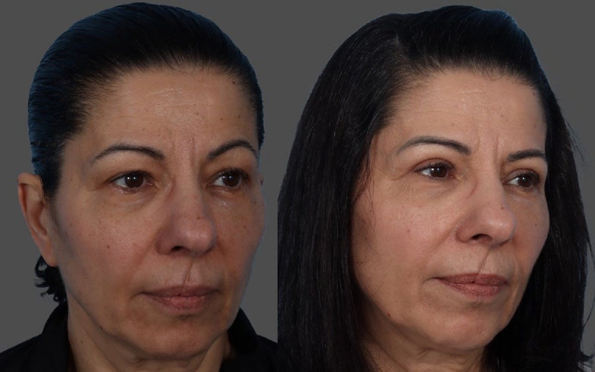Eyelid Surgery (Blepharoplasty) Before & After Gallery - Patient 369727 - Image 2
