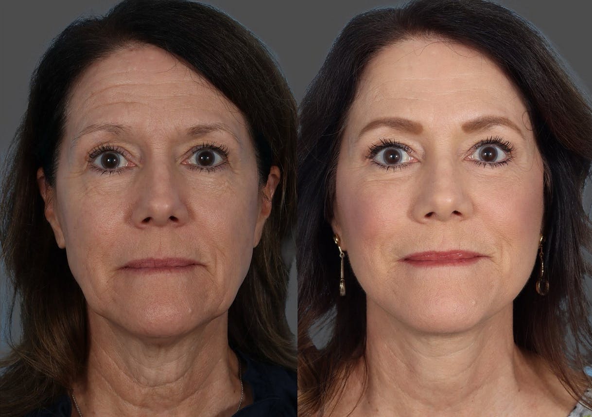 Facial Fat Transfer Before & After Gallery - Patient 686076 - Image 1