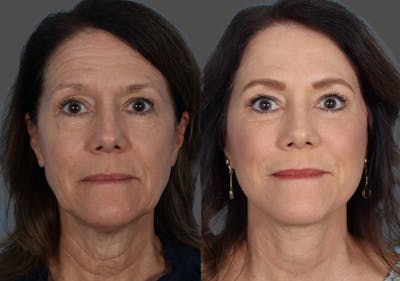 Facelift Before & After Gallery - Patient 242644 - Image 1