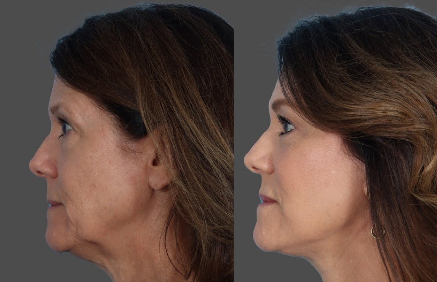 Facial Fat Transfer Before & After Gallery - Patient 686076 - Image 5