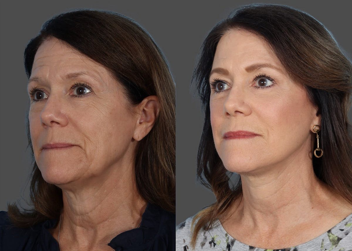 Facial Fat Transfer Before & After Gallery - Patient 686076 - Image 4