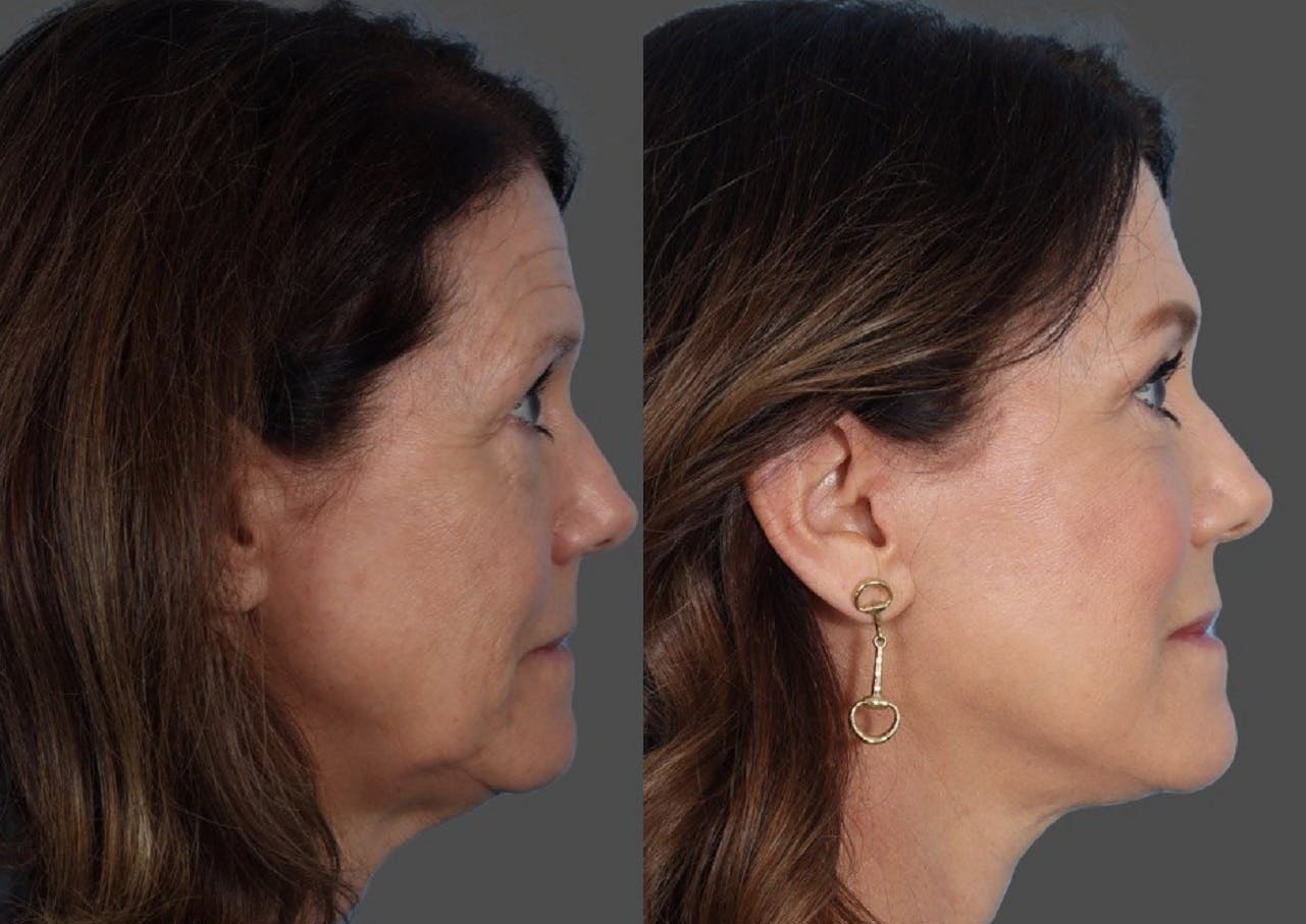 Facial Fat Transfer Before & After Gallery - Patient 686076 - Image 3