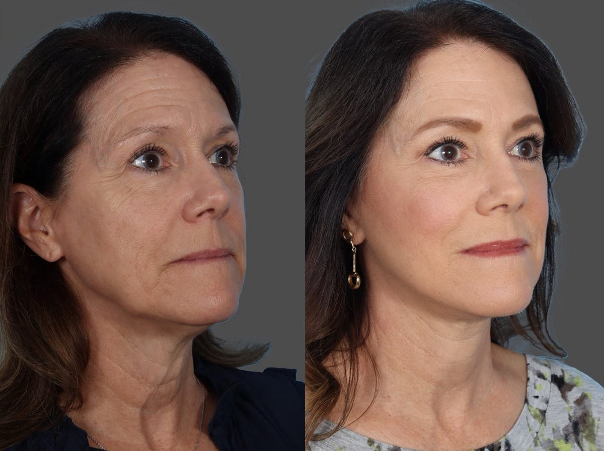 Facial Fat Transfer Before & After Gallery - Patient 686076 - Image 2