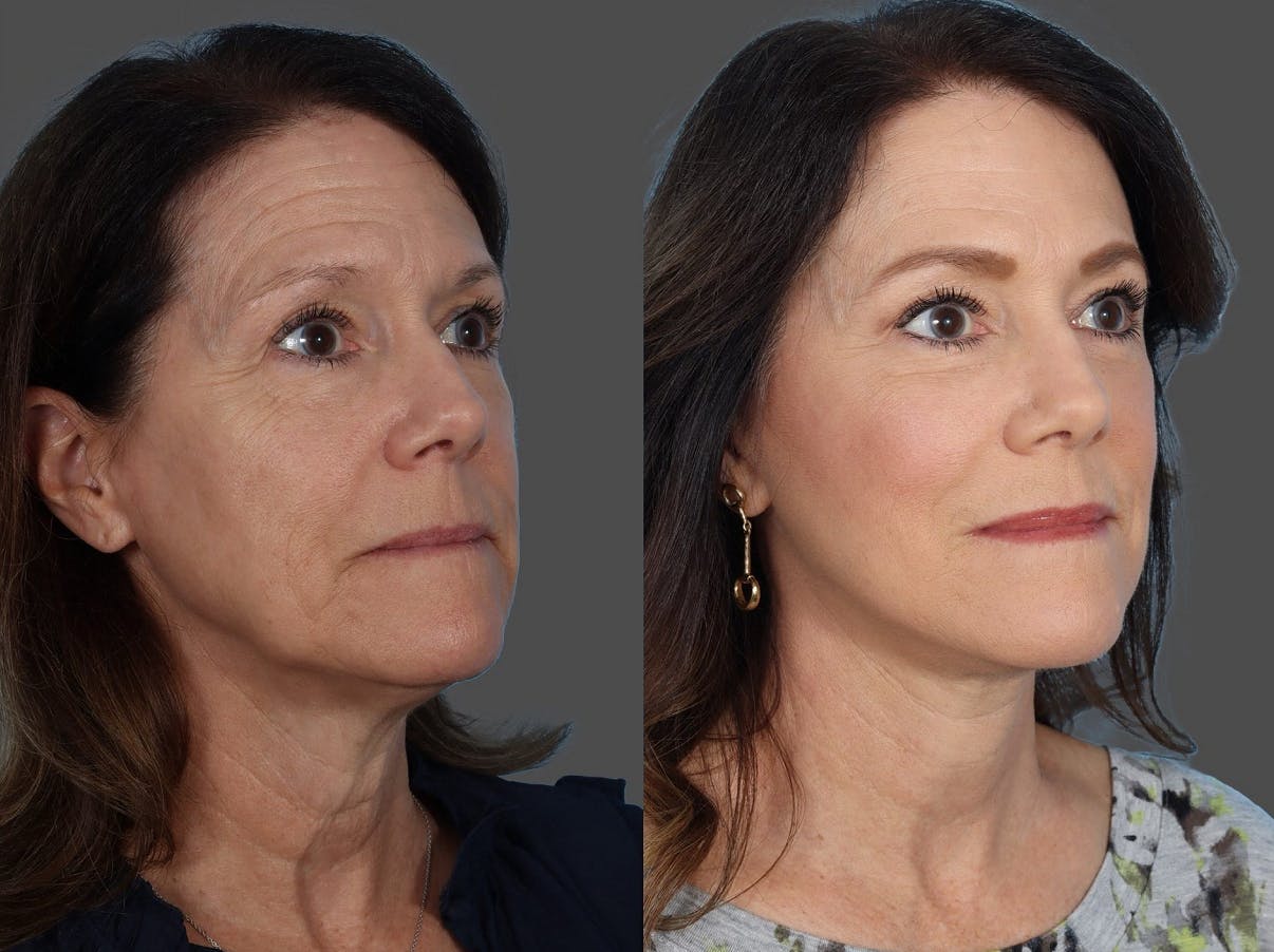 Facial Fat Transfer Before & After Gallery - Patient 686076 - Image 2