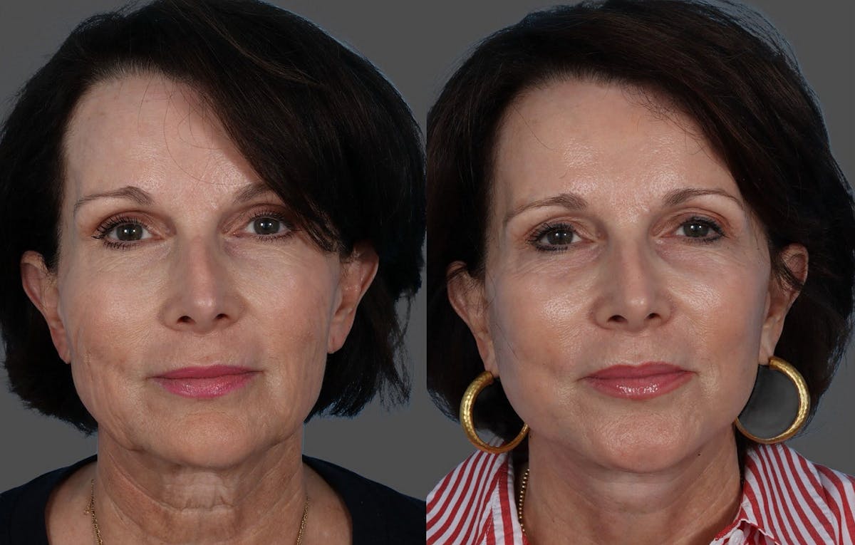 Facial Fat Transfer Before & After Gallery - Patient 285225 - Image 1