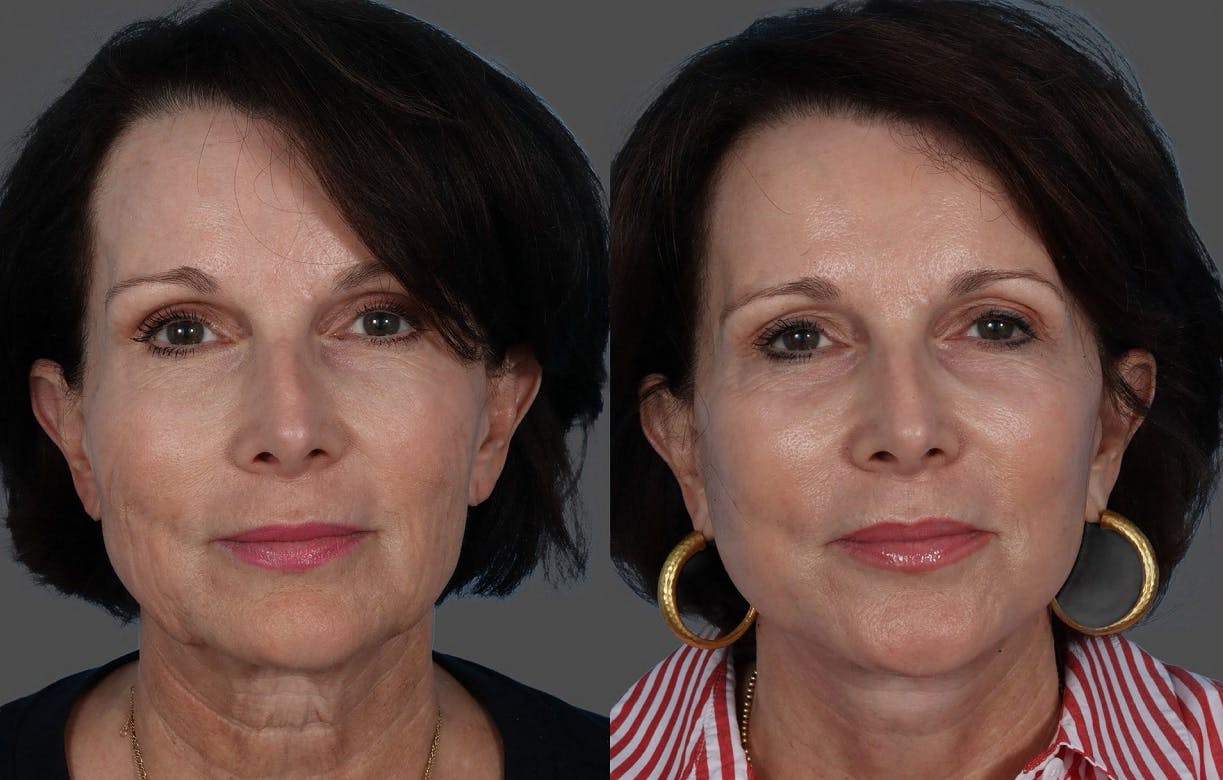 Facial Fat Transfer Before & After Gallery - Patient 285225 - Image 1
