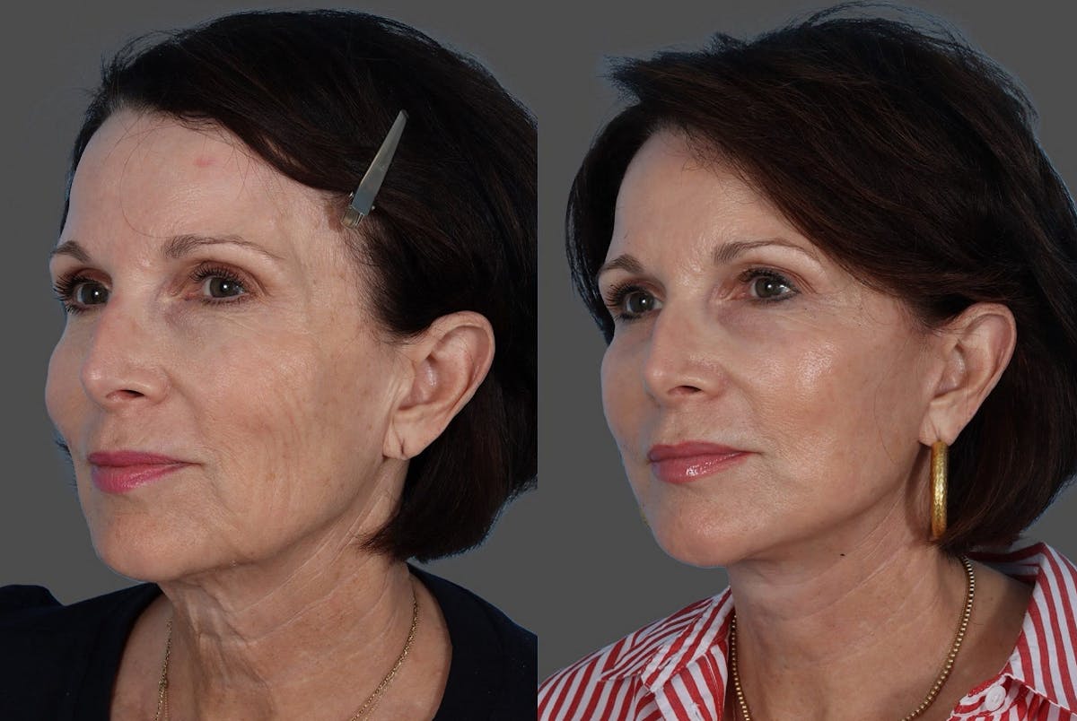 Facial Fat Transfer Before & After Gallery - Patient 285225 - Image 4