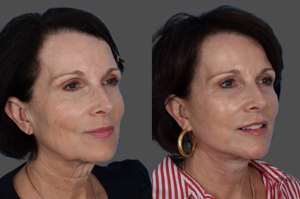 Facial Fat Transfer Before & After Gallery - Patient 285225 - Image 2