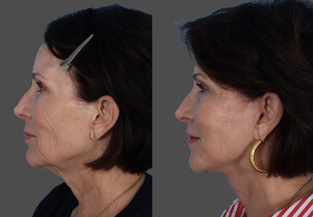 Facial Fat Transfer Before & After Gallery - Patient 285225 - Image 5