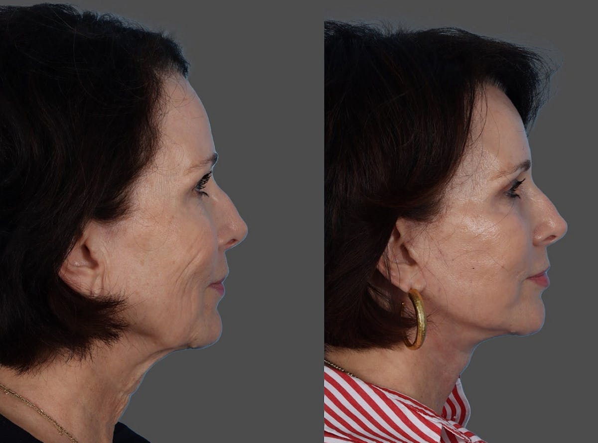 Facial Fat Transfer Before & After Gallery - Patient 285225 - Image 3